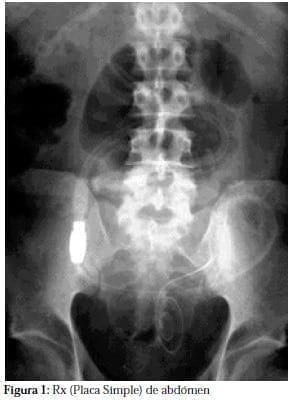 Rx (Placa Simple) de abdómen Rx (Placa Simple) de abdómen