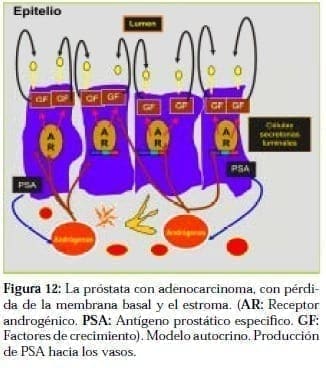 Próstata con Adenocarcinoma Próstata con Adenocarcinoma