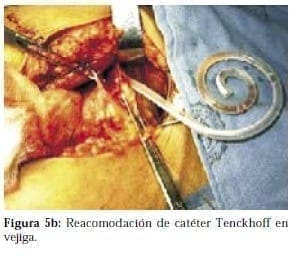 Recomodación de Catéter Tenckhoff en Vejiga Recomodación de Catéter Tenckhoff en Vejiga