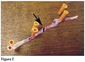 Tejido Graso Submucoso