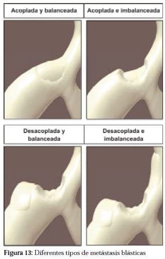 Tipos de Metástasis Blásticas Tipos de Metástasis Blásticas