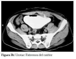 Urotac: Extremos del Catéter Urotac: Extremos del Catéter