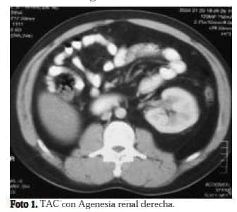 TAC con Agenesia renal derecha TAC con Agenesia renal derecha