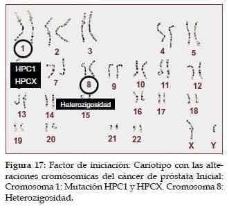 Cariotipo con las alteraciones cromósomicas del Cáncer de Próstata Cariotipo con las alteraciones cromósomicas del Cáncer de Próstata