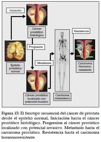 Fenotipo secuencial del Cáncer de Próstata Fenotipo secuencial del Cáncer de Próstata