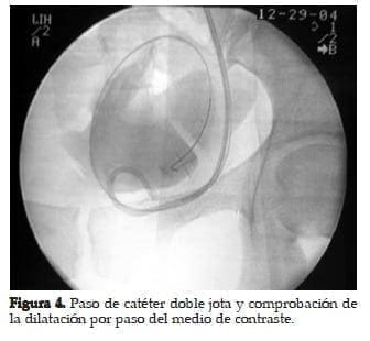 Paso de Catéter doble Jota Paso de Catéter doble Jota