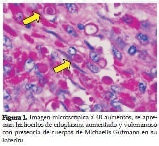 Histiocitos de Citoplasma aumentado y voluminoso Histiocitos de Citoplasma aumentado y voluminoso
