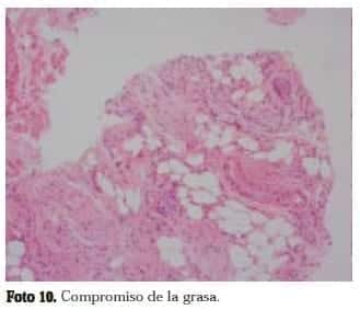 Adenocarcinoma de Próstata: Compromiso de la grasa Adenocarcinoma de Próstata: Compromiso de la grasa