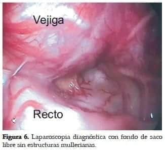 Cordones Vasculares Gonadales que se dirigen al Conducto Inguinal Cordones Vasculares Gonadales que se dirigen al Conducto Inguinal