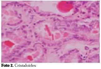 Cristaloides en glándulas malignas Cristaloides en glándulas malignas