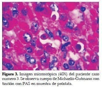 Cuerpo de Michaelis-Gutmann con Tinción con PAS en muestra de Próstata
