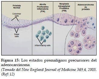 Estados Premalignos Precursores Estados Premalignos Precursores