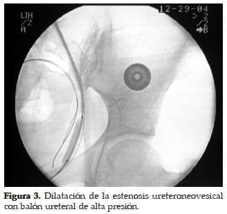 Dilatación de la Estenosis Ureteroneovesical Dilatación de la Estenosis Ureteroneovesical