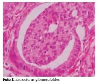 Estructuras Glomeruloides Estructuras Glomeruloides