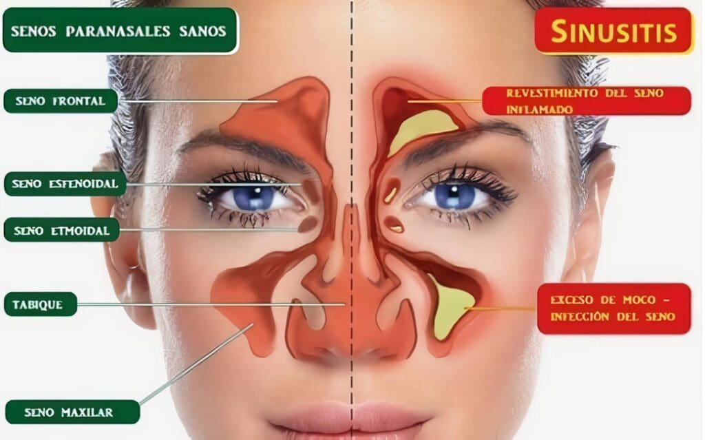 Granulomatosis de Wegener