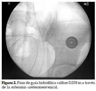 Paso de guía Hidrofilica Paso de guía Hidrofilica