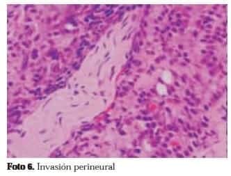 Invasión Perineural Invasión Perineural