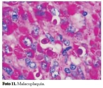 Adenocarcinoma de Próstata: Malacoplaquia Adenocarcinoma de Próstata: Malacoplaquia