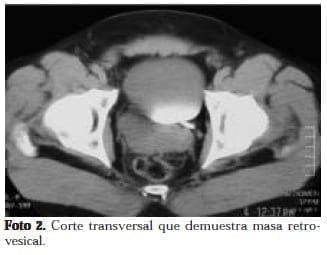 Corte transversal que demuestra Masa Retrovesical Corte transversal que demuestra Masa Retrovesical