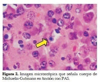 Cuerpo de Michaelis-Gutmann en Tinción con PAS Cuerpo de Michaelis-Gutmann en Tinción con PAS