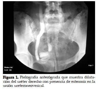 Dilatación del Uréter derecho con presencia de Estenosis