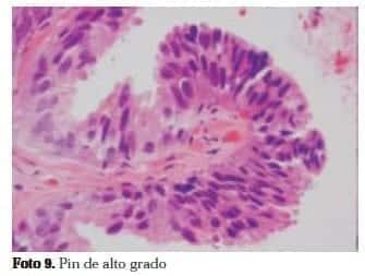 Adenocarcinoma de Próstata: Pin de alto grado Adenocarcinoma de Próstata: Pin de alto grado