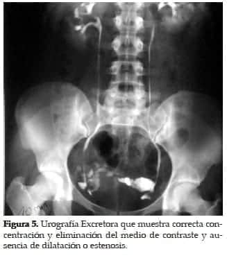 Urografía Excretora ausencia de Estenosis Urografía Excretora ausencia de Estenosis