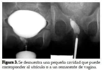 Utrículo Prostático o a la Vagina Utrículo Prostático o a la Vagina