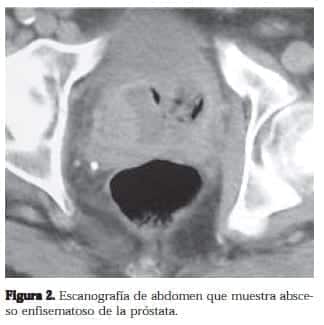 Absceso Enfisematoso de la Próstata