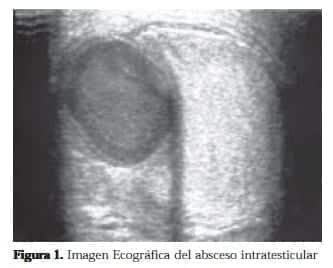 Imagen Ecográfica del Absceso Intratesticular