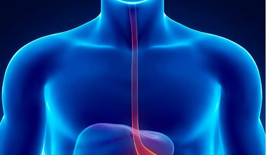 Acalasia Esofágica