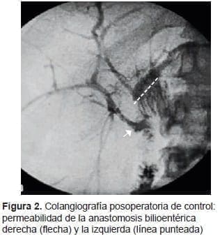 Anastomosis Bilioentérica derecha Anastomosis Bilioentérica derecha