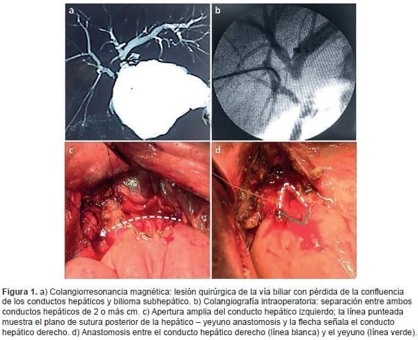 Anastomosis entre el conducto Hepático derecho y el Yeyuno Anastomosis entre el conducto Hepático derecho y el Yeyuno