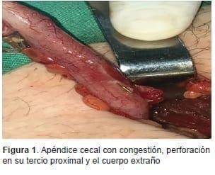 Apéndice Cecal con Congestión Apéndice Cecal con Congestión