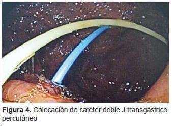 Colocación de Catéter doble J Transgástrico Percutáneo Colocación de Catéter doble J Transgástrico Percutáneo