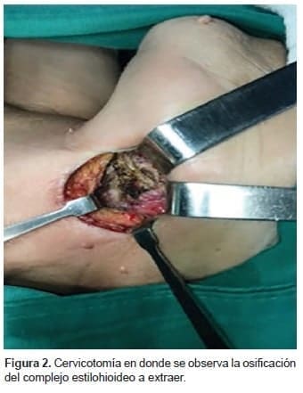 Cervicotomía se observa la Osificación del complejo Estilohioideo Cervicotomía se observa la Osificación del complejo Estilohioideo