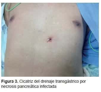 Cicatriz del Drenaje Transgástrico por Necrosis Pancreática Infectada Cicatriz del Drenaje Transgástrico por Necrosis Pancreática Infectada