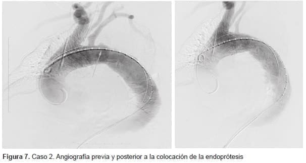 Angiografía previa y posterior a la colocación de la Endoprótesis Angiografía previa y posterior a la colocación de la Endoprótesis