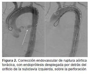 Corrección Endovascular de ruptura Aórtica Torácica Corrección Endovascular de ruptura Aórtica Torácica