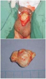 Lito uretral de 10x5 cms. en uretra penano-Bulbar Lito uretral de 10x5 cms. en uretra penano-Bulbar