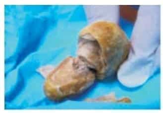 Presencia de Dispositivo Intrauterino Presencia de Dispositivo Intrauterino