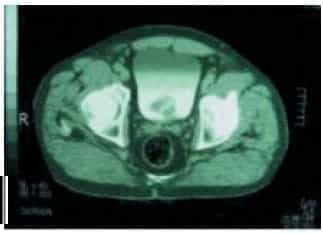 Dolor tipo Picada localizado en Hipogastrio Dolor tipo Picada localizado en Hipogastrio