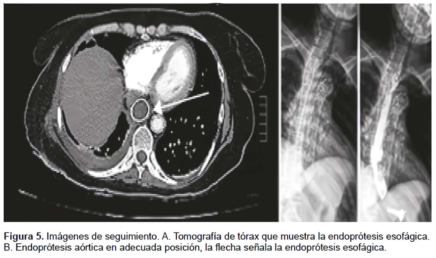 Tomografía de Tórax: Endoprótesis Esofágica y Endoprótesis Aórtica Tomografía de Tórax: Endoprótesis Esofágica y Endoprótesis Aórtica