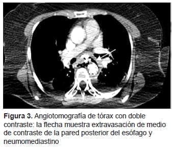 Extravasación, Pared posterior del Esófago y Neumomediastino Extravasación, Pared posterior del Esófago y Neumomediastino