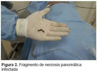 Fragmento de Necrosis Pancreática Infectada Fragmento de Necrosis Pancreática Infectada