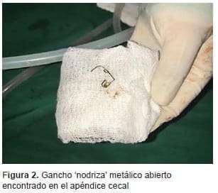 Gancho Nodriza, Encontrado en el Apéndice Cecal Gancho Nodriza, Encontrado en el Apéndice Cecal