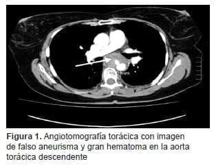 Gran Hematoma en la Aorta Torácica Descendente Gran Hematoma en la Aorta Torácica Descendente