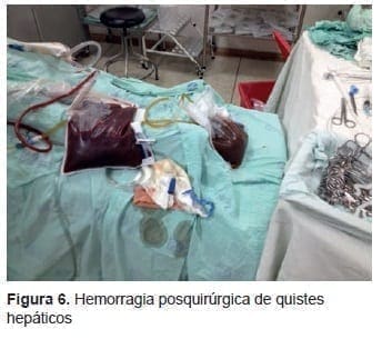 Hemorragia Posquirúrgica de Quistes Hepáticos Hemorragia Posquirúrgica de Quistes Hepáticos