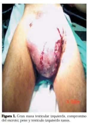 Gran masa Testicular Izquierda