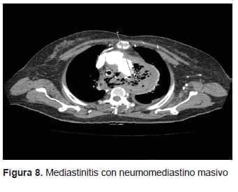 Mediastinitis con Neumomediastino Masivo Mediastinitis con Neumomediastino Masivo